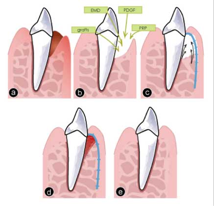 Guided Bone and Tissue Regeneration