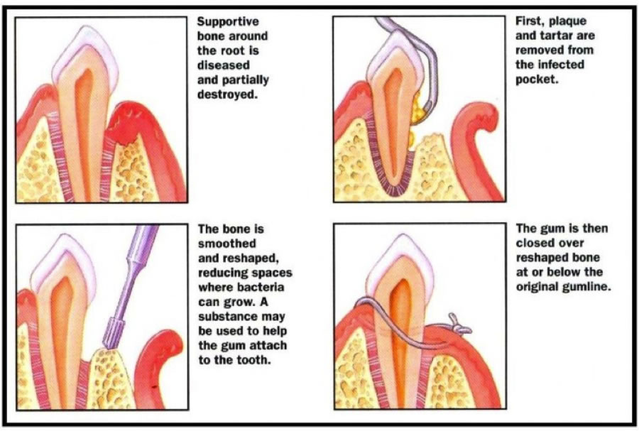 Pocket Reduction Surgery